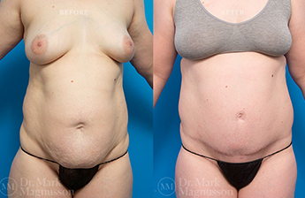 Abdominoplasty-Overweight - 18