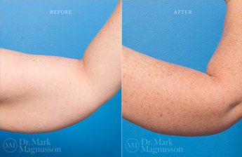 Arm Reduction - Normal Weight - 1