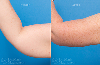 Arm Reduction - Normal Weight - 2