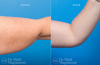 Arm Reduction - Normal Weight - 3