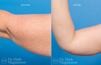 Arm Reduction - Normal Weight - 4