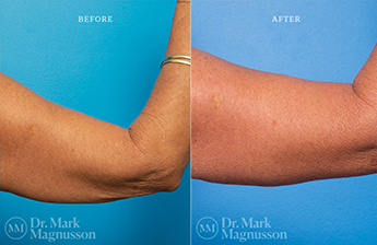 Arm Reduction - Normal Weight - 5