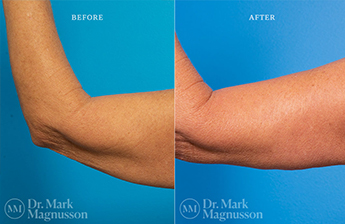 Arm Reduction - Normal Weight - 6