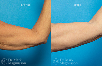 Arm Reduction - Normal Weight - 7