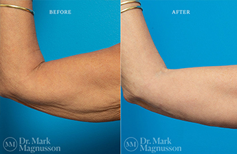 Arm Reduction - Normal Weight - 8