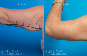 Arm Reduction - Obese - 1