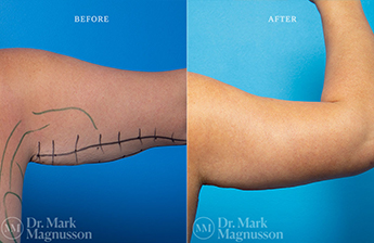 Arm Reduction - Obese - 2