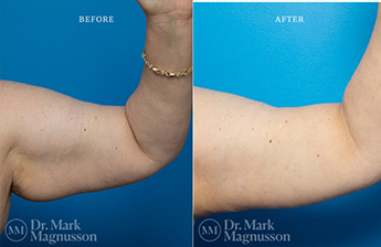 Arm Reduction - Obese - 3