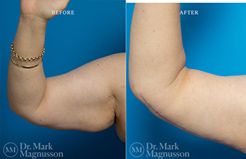 Arm Reduction - Obese - 4