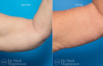 Arm Reduction - Obese - 5