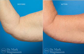 Arm Reduction - Obese - 6