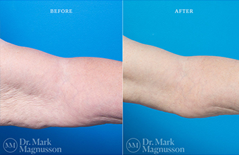 Arm Reduction - Overweight - 1