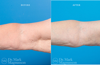 Arm Reduction - Overweight - 2