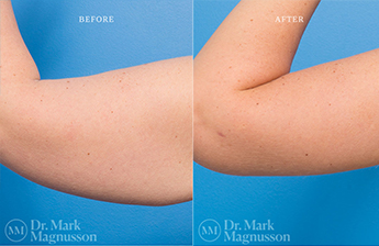 Arm Reduction - Overweight - 3