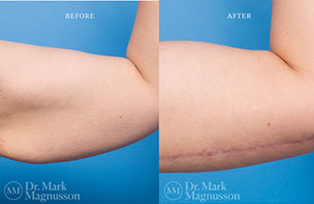 Arm Reduction - Overweight - 4