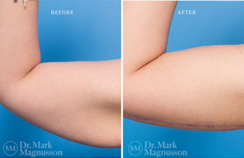 Arm Reduction - Overweight - 5