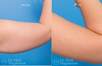 Arm Reduction - Overweight - 6