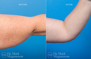 Arm Reduction - Normal Weight - 9