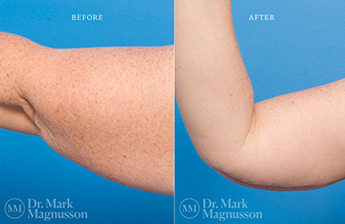 Arm Reduction - Normal Weight - 10