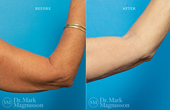 Arm Reduction - Normal Weight - 11