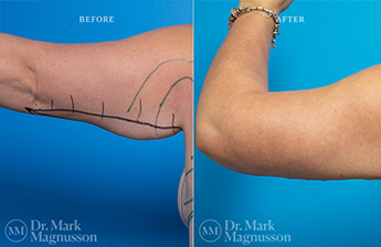 Arm Reduction - Obese - 7