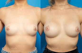 Asymmetry Correction and Breast Augmentation Gallery - 3
