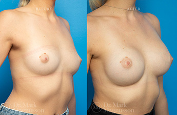 Asymmetry Correction and Breast Augmentation Gallery - 4