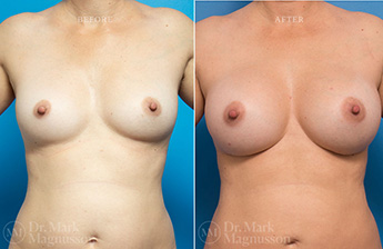 Asymmetry Correction and Breast Augmentation Gallery - 5