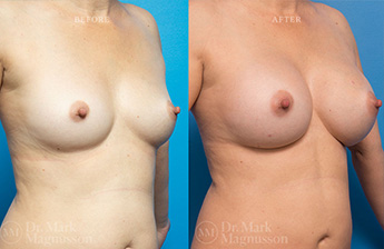 Asymmetry Correction and Breast Augmentation Gallery - 6