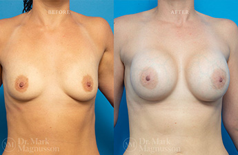 Asymmetry Correction and Breast Augmentation Gallery - 7