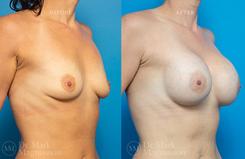 Asymmetry Correction and Breast Augmentation Gallery - 8