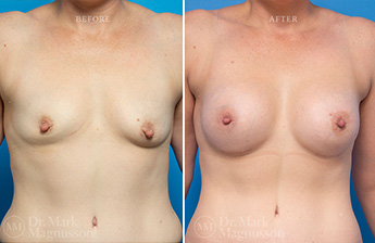 Asymmetry Correction and Breast Augmentation Gallery - 11