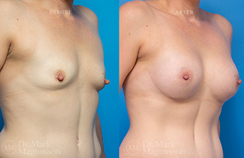Asymmetry Correction and Breast Augmentation Gallery - 12