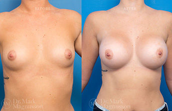 Asymmetry Correction and Breast Augmentation Gallery - 13
