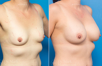 Low Nipple - 8