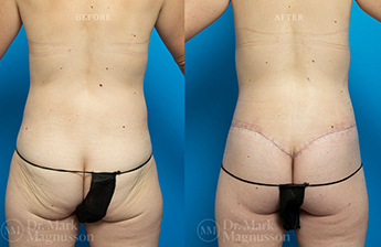 BodyLift Breast Augmentation- Normal Weight - 3