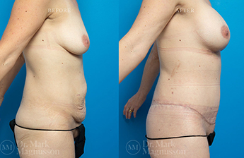 BodyLift Breast Augmentation- Normal Weight - 4