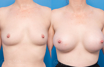 Breast Grafting - 1