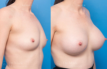 Breast Grafting - 2