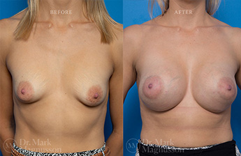 Breast Grafting - 3