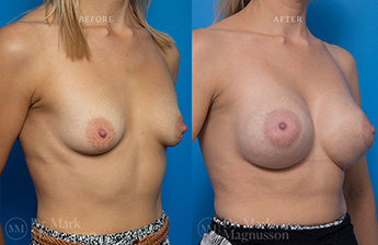 Breast Grafting - 4