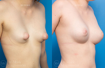 Breast Grafting - 6