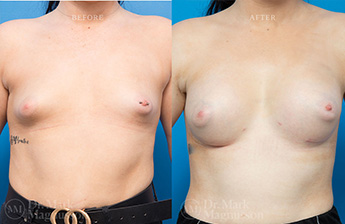 Breast Grafting - 7