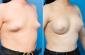 Breast Grafting - 8