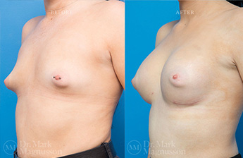 Breast Grafting - 9