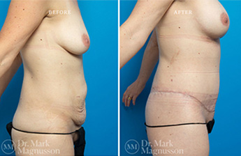 Bodylift – Upperbody - 5