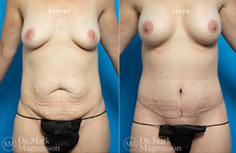 Bodylift – Upperbody - 7