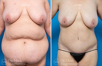 Bodylift - Lowerbody- Obese - 1