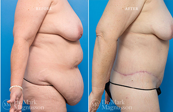 Bodylift - Lowerbody- Obese - 2