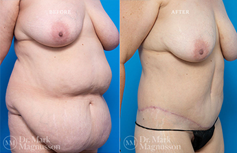 Bodylift - Lowerbody- Obese - 3